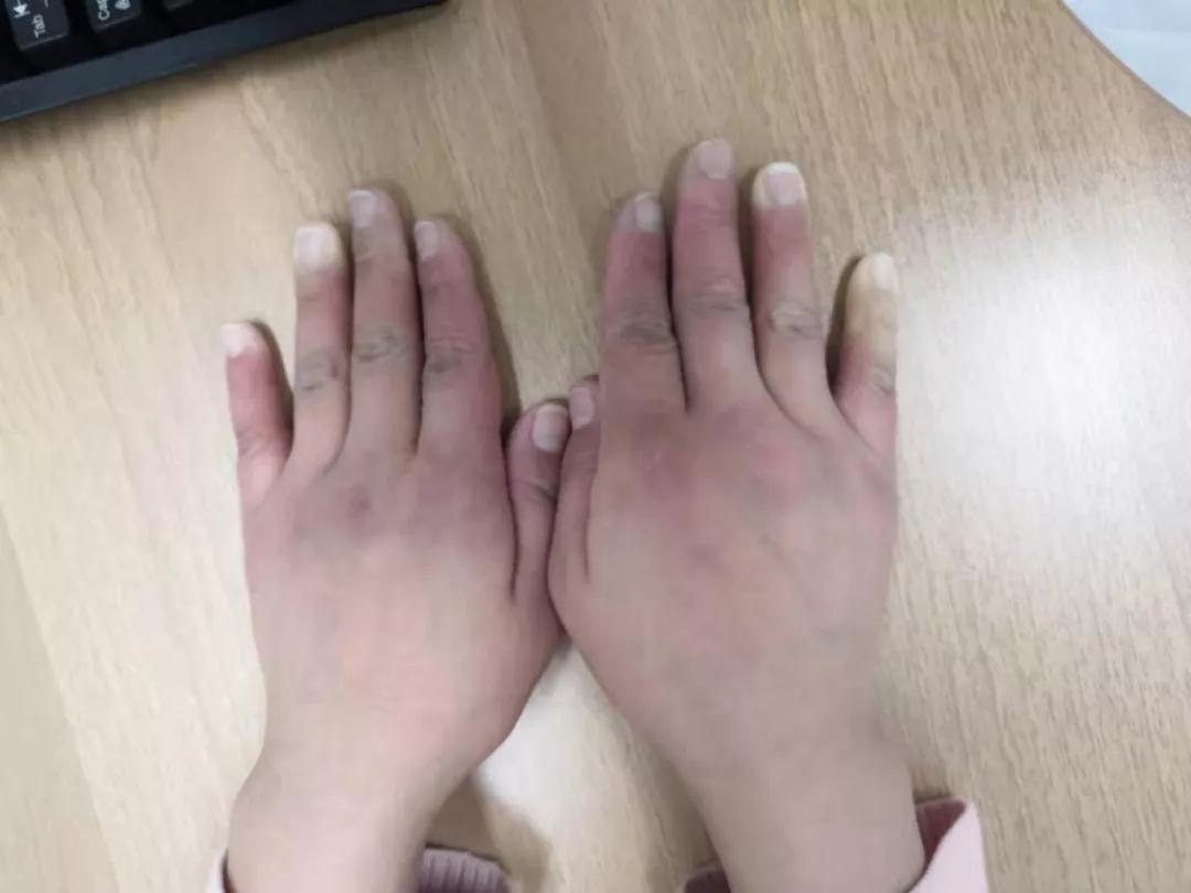 “手指、腳趾發(fā)白、發(fā)紫……”這些“小毛病”千萬(wàn)別大意