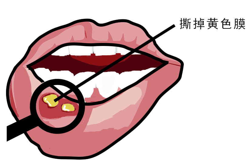 經(jīng)?？谇粷儯娴闹皇侨本S生素嗎？